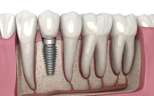 Top Dental Implant Services screenshot 1